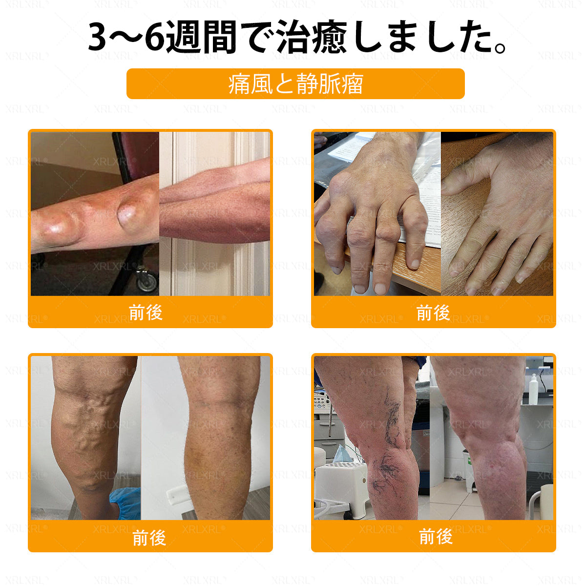 🇯🇵 日本製・日本から直送 🌱XRLXRL®🐝 ミツバチ毒配合🦴 関節・膝・腰・肩を毎日ケア✨ 軽やかな動きをサポート💚